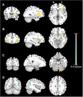 Intrinsic Brain Activity Responsible for Sex Differences in Shyness and Social Anxiety